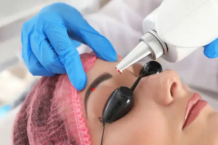 A person wearing a pink hair net and protective goggles is receiving a laser treatment on their forehead. A professional, whose hands are shown wearing blue gloves, is operating the laser device aimed at a precise spot on the person's forehead.