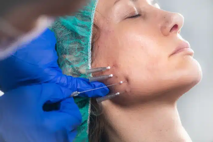 A person with closed eyes is receiving a cosmetic procedure. They are wearing a green hairnet and white headband, while a medical professional with blue gloves inserts multiple needles into the facial skin along the jawline and cheek.