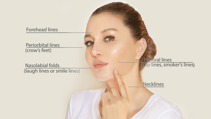 A woman with clear skin points to her chin. Labels indicate different types of facial lines: forehead lines, periorbital lines (crow's feet), nasolabial folds (laugh lines or smile lines), perioral lines (lip lines, smoker's lines), and necklines.