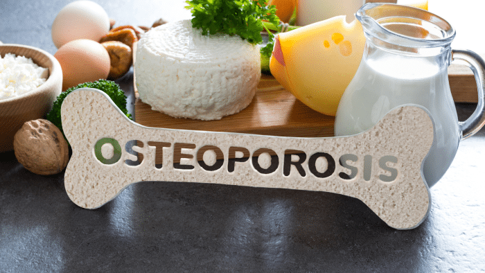 An assortment of dairy products, including a jug of milk, cheese, and eggs, is arranged on a table. A bone-shaped sign with the word "OSTEOPOROSIS" in cutout letters is prominently displayed in the foreground.