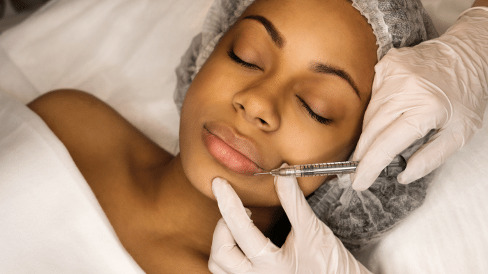 Teosyal filler treatment.