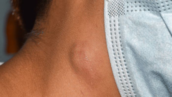 Close-up of a person's neck showing a small, raised bump under the skin near the jawline, partially covered by the strap of a disposable face mask. The bump appears slightly red and swollen. The skin texture around the area is clearly visible.