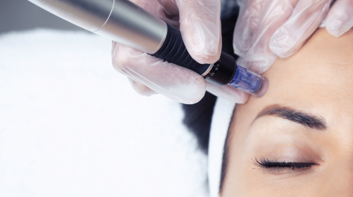 A close-up of a person's forehead during a microneedling procedure. The person has their eyes closed, and a technician wearing gloves is using a microneedling device on the person's skin. The person has a white headband on.