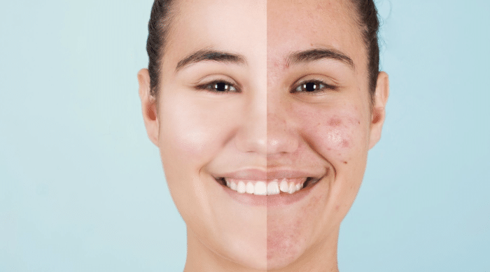 Close-up of a smiling person with split-face comparison. The left side features clear, smooth skin while the right side shows acne and redness. The background is a solid light blue.