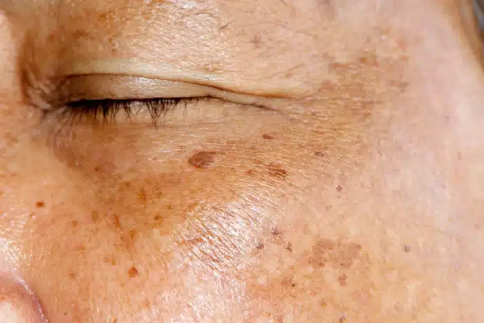 Close-up of a person's facial skin with several small, dark spots or freckles. The person's eye is closed, and the texture of the skin is clearly visible, showing some signs of aging, such as wrinkles and fine lines. This highlights how treatments like botox for melasma can offer rejuvenation.
