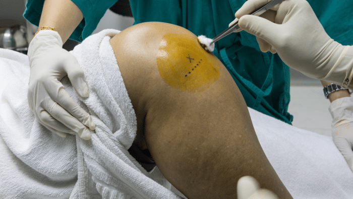 A close-up of a person's knee being prepared for a medical procedure. The knee is covered with an antiseptic solution, marked with an 'X'. A gloved hand holds a cotton swab instrument, and the leg is wrapped in a white towel.