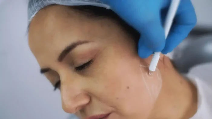 Sculptra Jowls Tighten Skin Around Jawline