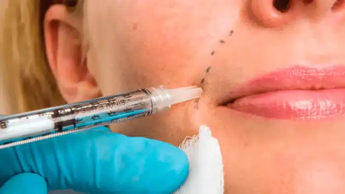 A close-up image shows a syringe being used for a cosmetic procedure on a person's cheek. A gloved hand holds the syringe, and the patient's skin has dotted guideline markings near the mouth.
