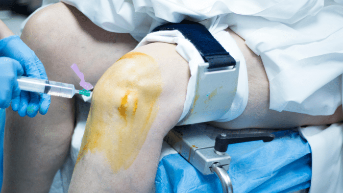 A medical professional in blue gloves prepares an injection for a patient's knee. The knee is secured in a brace and has been cleaned with antiseptic, evidenced by the orange tint. The patient is draped with a white sheet.