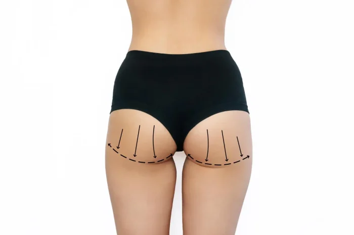 Person wearing black shorts viewed from behind with drawn arrows and lines indicating enhancement or lifting of the buttock area. The background is white.