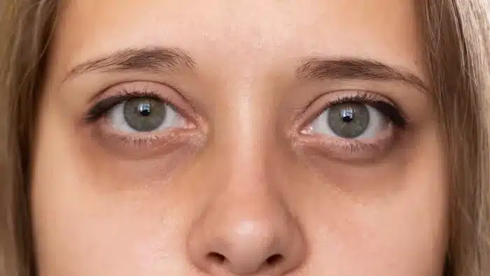 Woman with deep eye bags.