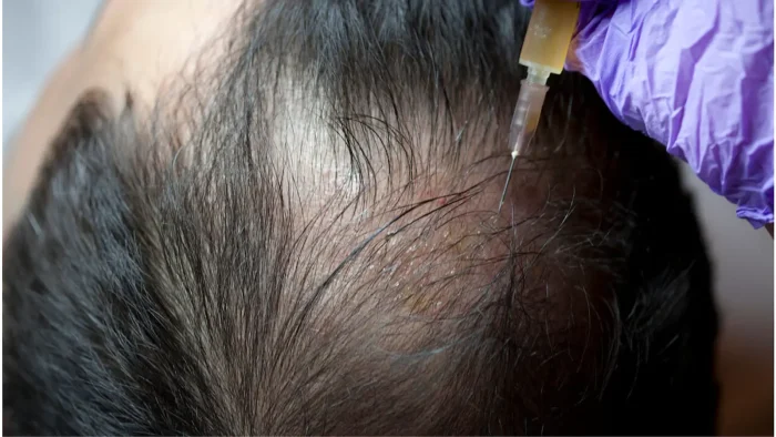 A person receives an injection on the scalp, where hair is thinning. The procedure is performed by a gloved hand with a syringe.