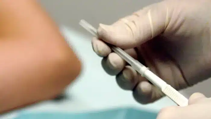A gloved hand holds a medical tool in a clinical setting, with a blurred background showing a patient's arm and a blue sheet.