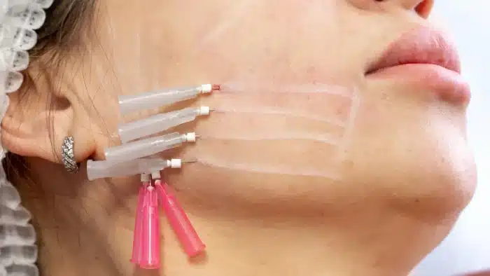 Close-up of a person's cheek undergoing a cosmetic procedure with multiple small cannulas inserted into the skin. The face is marked with white lines, and the person wears a protective cap.
