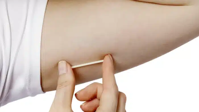 A hand pressing on a thin, rod-shaped object beneath the skin of an upper arm, illustrating the insertion of a contraceptive implant. The person is wearing a white garment.
