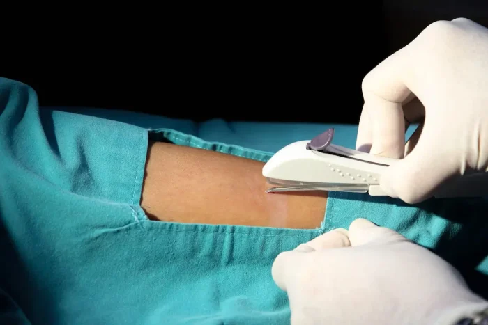 A close-up of a medical procedure where a person in surgical gloves uses a stapler to close an incision on a patient's arm. The surrounding area is covered with a teal surgical drape.