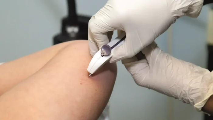 A gloved hand holds a small medical device against a person's arm, possibly administering a treatment or medication. The background is blurred, focusing on the procedure.