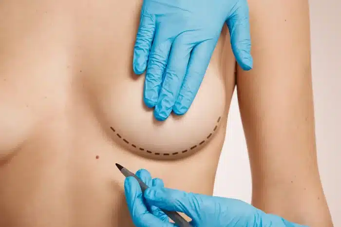 A person wearing blue gloves marks a dotted line on the undercurve of a woman's breast with a marker, suggesting preparation for a surgical procedure.