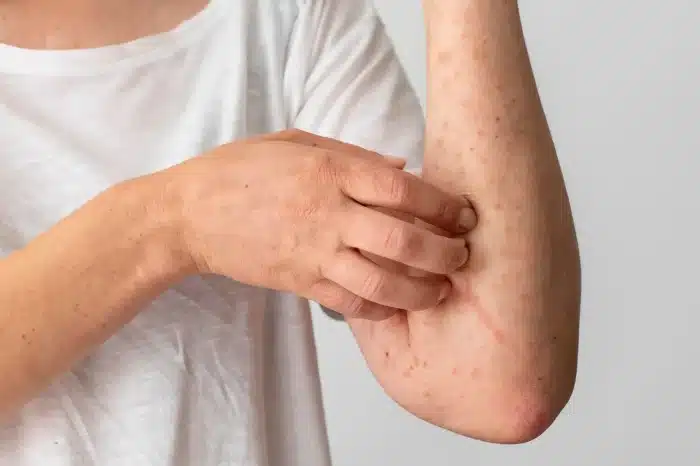 A person in a white shirt scratches their forearm, which has visible red spots and skin irritation. The background is plain and neutral.