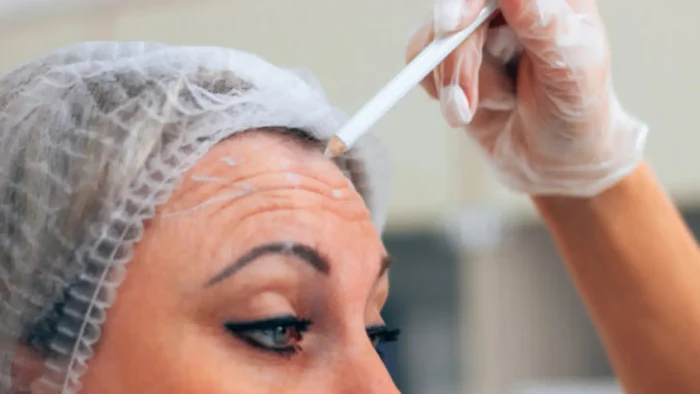 A person wearing a hair net and gloves uses a white pencil to mark lines on another person's forehead, possibly in preparation for a cosmetic or medical procedure.