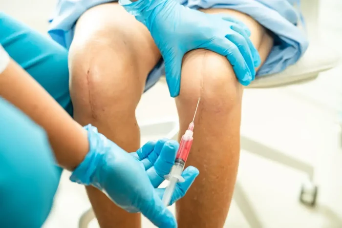 A healthcare professional wearing blue gloves prepares to inject a syringe filled with red fluid into a patient’s knee. The patient has visible surgical scars on both knees and is sitting on a chair in a clinical setting.