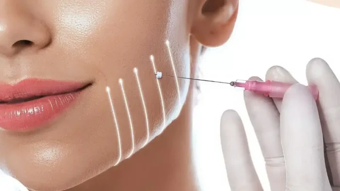 A close-up of a woman’s face receiving a cosmetic procedure. A gloved hand holds a needle near her cheek, with white lines drawn on her skin indicating treatment areas.